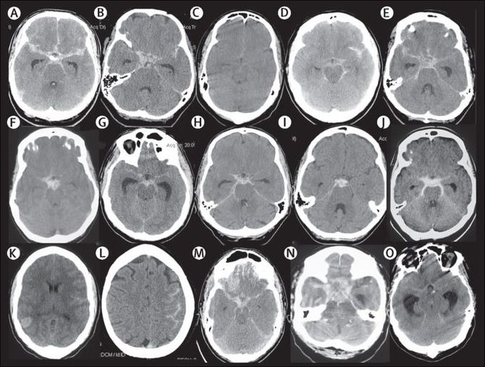 Signs and Symptoms of Subarachnoid Hemorrhage