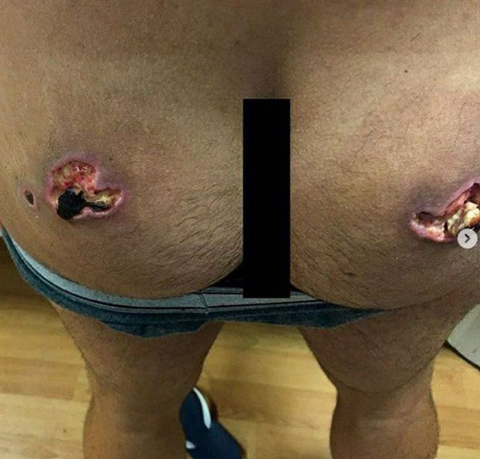 Necrosis Of Skin Over The Buttocks of a Bodybuilder - MEDizzy Journal