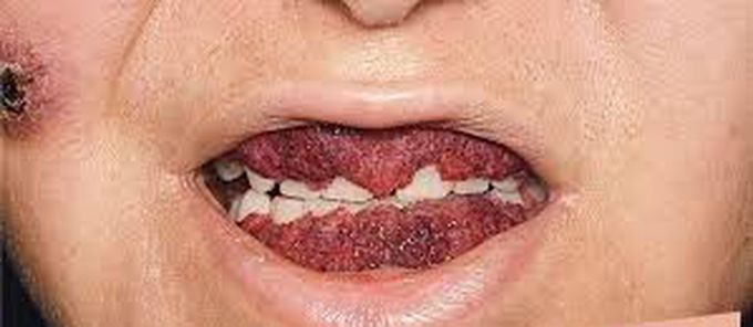 Causes of strawberry gingivitis