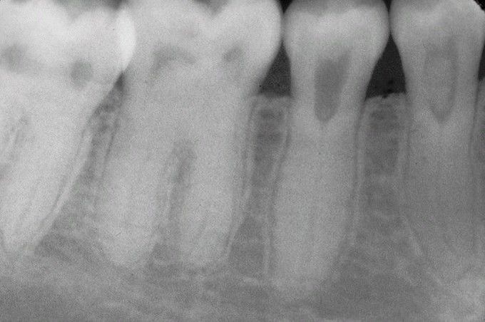 Dentin Dysplasia Type II (DD-II).