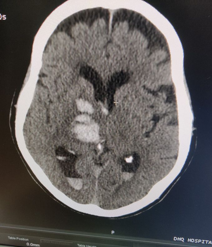 Hemorrhagic CVA