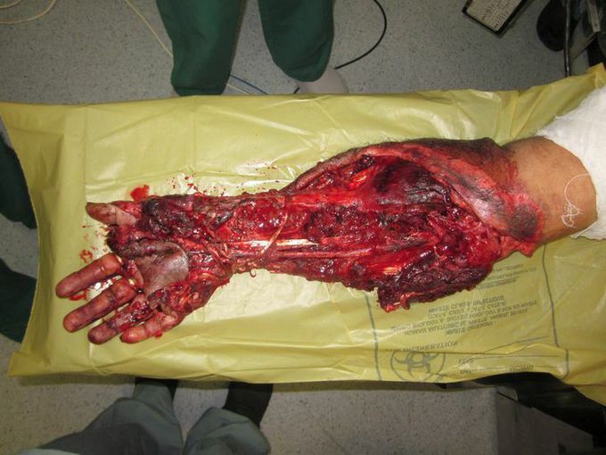 AN EXTREME TRAUMA
