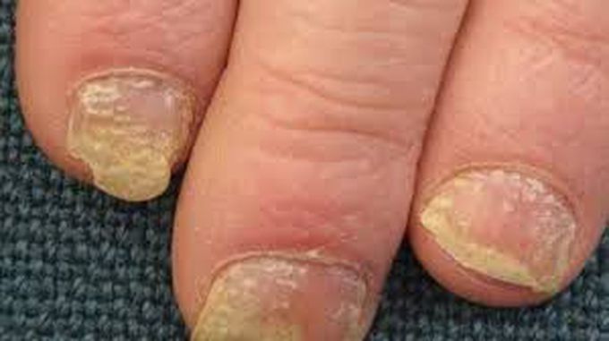 Nail psoriasis