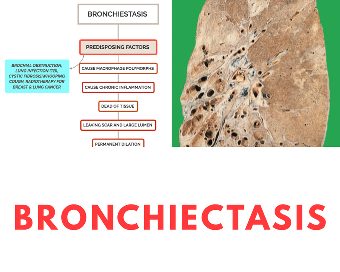 BRONCHIECTASIS