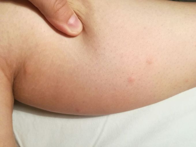Bites from bed, unknown source