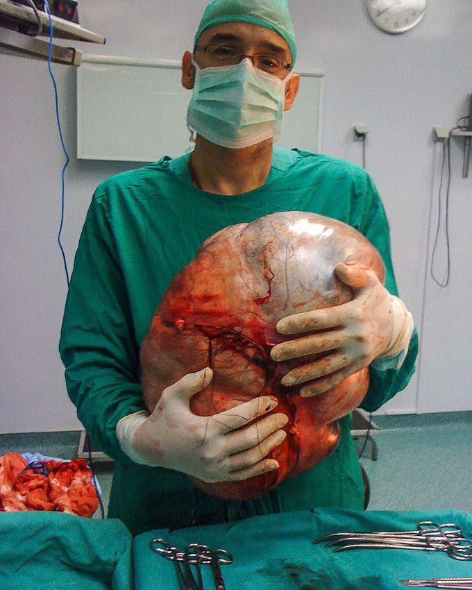 It’s a good day to hold an enormous ovarian cyst!!