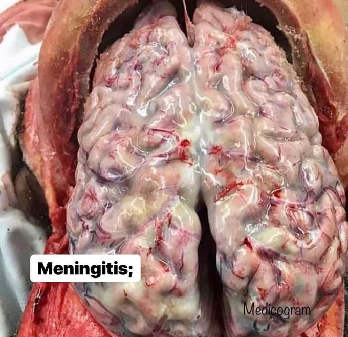 Bacterial Meningitis 