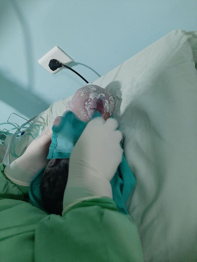 Hydrocephalus+ spinabifida case.
