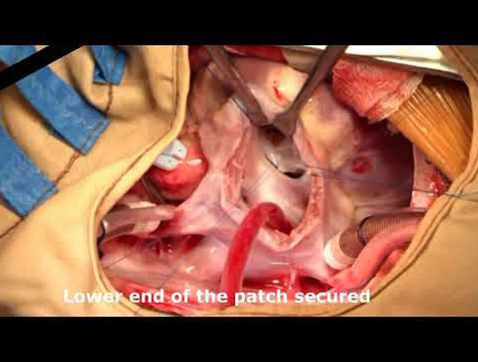 Repair of Complete Atrioventricular Septal Defect by Two Patch Technique