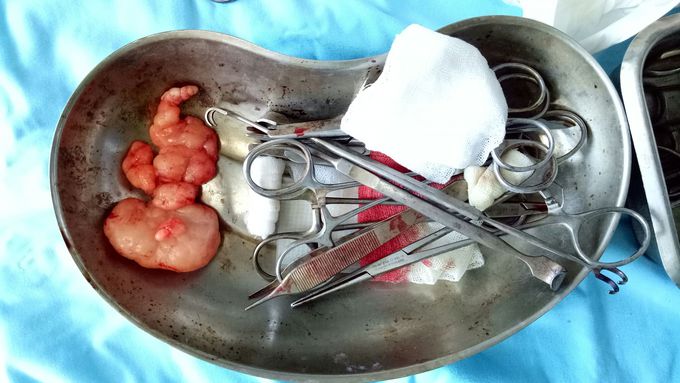 Lipoma