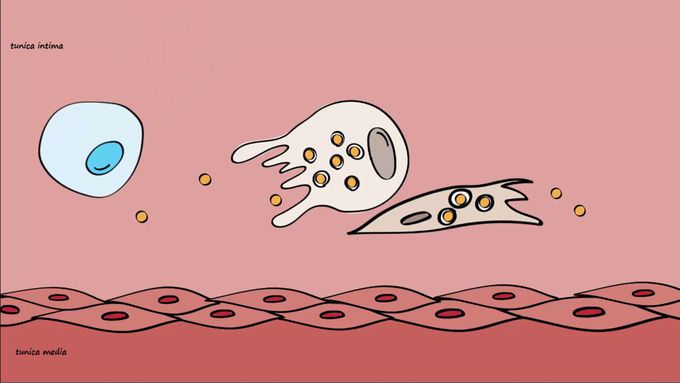 Atherosclerosis- An Insight into its Pathogenesis