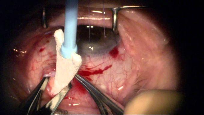 Combining Cataract and Glaucoma Surgery