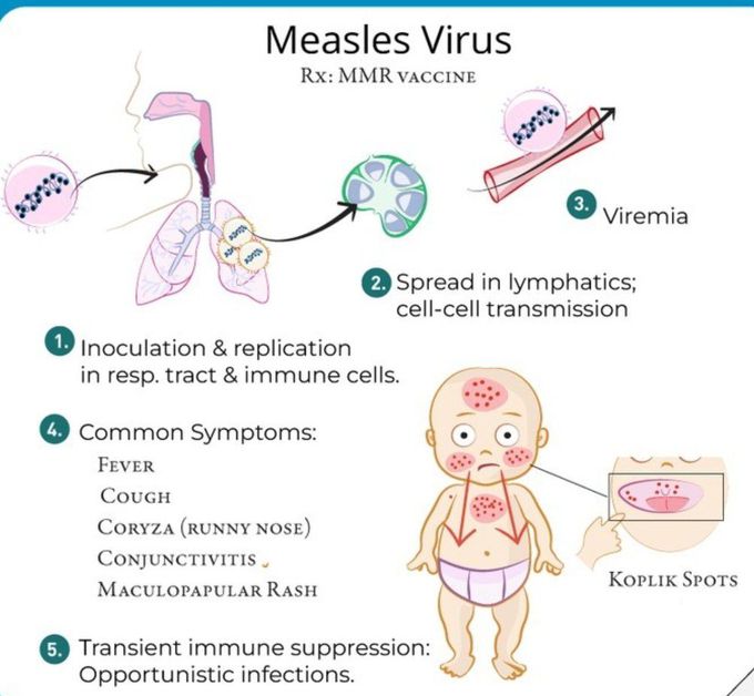 Measles