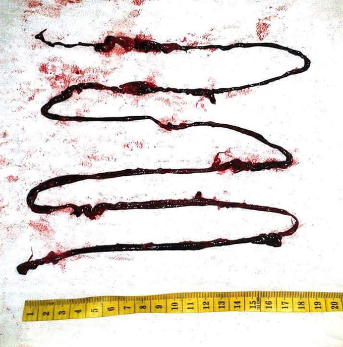 Femoral embolectomy