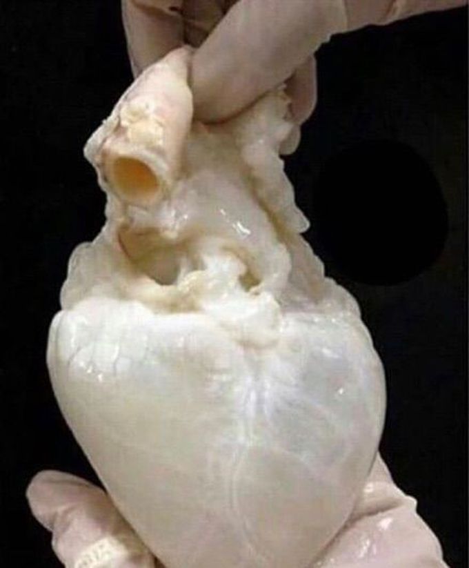 human heart out of blood