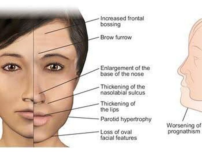 Acromegaly