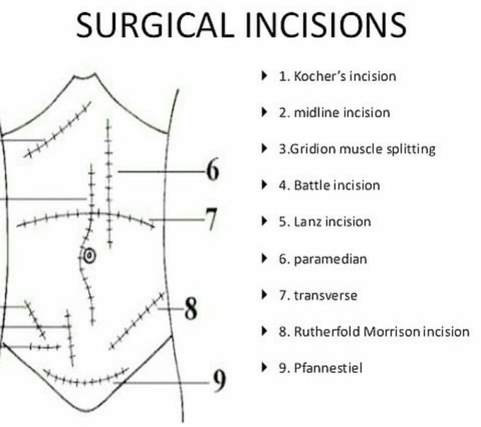 Types of Incisions