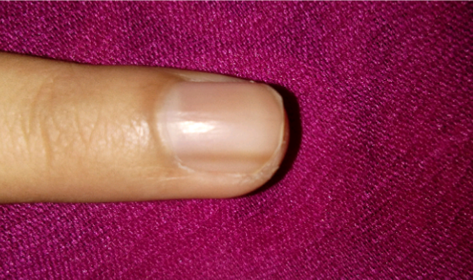 What Does A Brown Line On Your Nail Mean