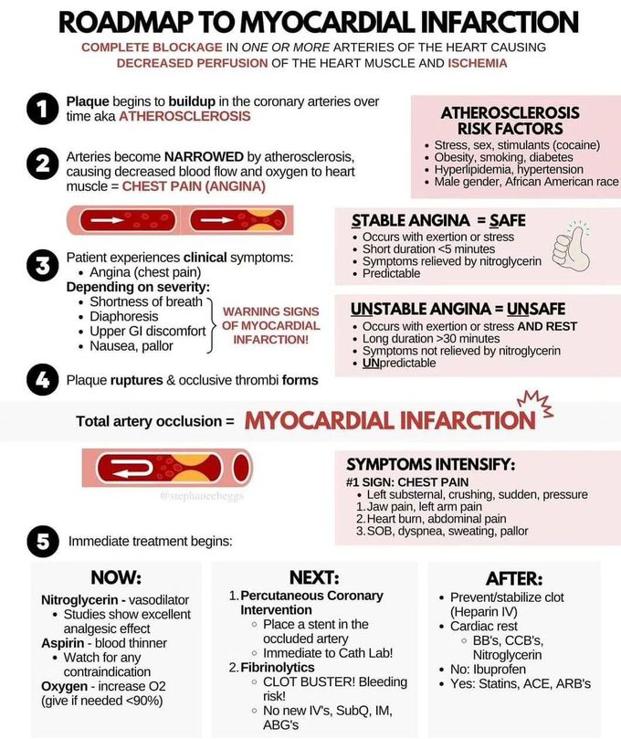Roadmap to Myocardial Infarction