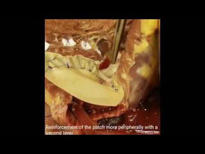 Ischemic VSD Repair With Transapical Mitral Valve Replacement