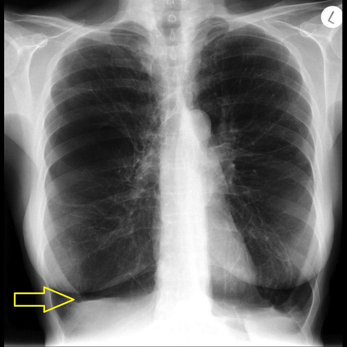 Radiograph Features in Emphysema