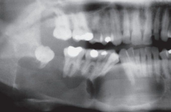 Odontogenic keratocyst