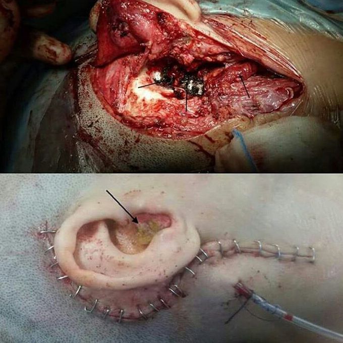 Glomus jugulare tumor