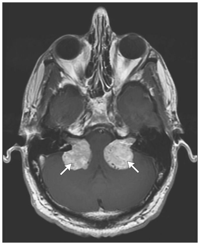 Bilateral Vestibular Schwannomas in Neurofibromatosis Type 2