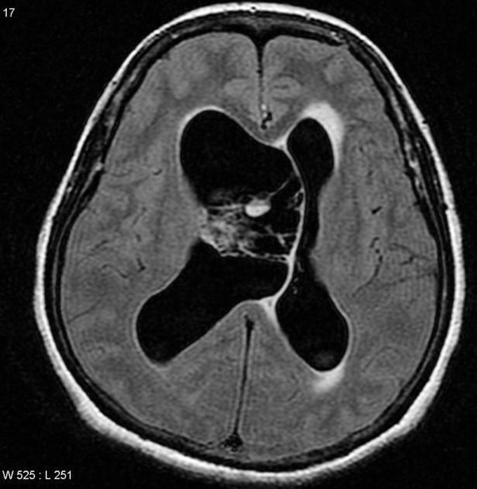 Neurocytomal image of person with abnormal seizure s, hallucinations,aphasia and epidural necrosis