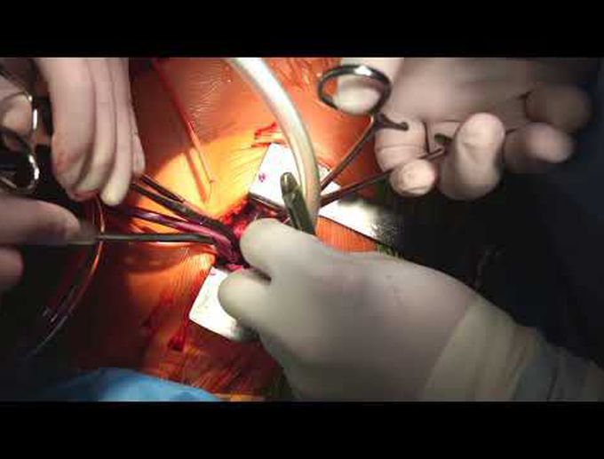 Right Minithoracotomy AVR Using Central Cannulation, Sutureless Bioprosthesis