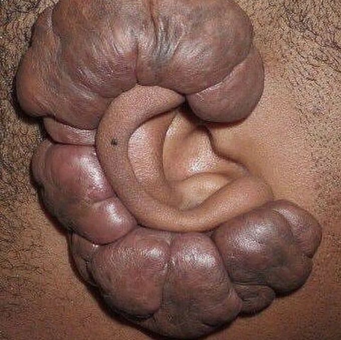 Keloid scar around the ear