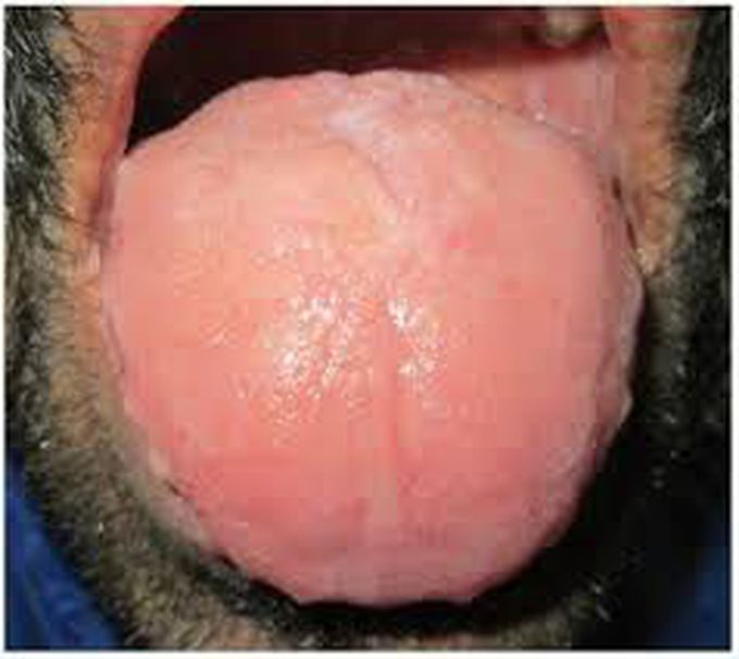 Cause of macroglossia