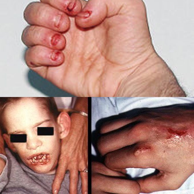 4 YO boy with severe repeated lip chewing