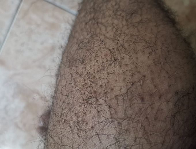 A male patient if age 33 years complaints of black dot or blackening around the hair pores.it is not associated with itching.it mostly seen in thigh.No history of smoking, htn,daibetis. There is slight elevation in triglycerides..IMAGE FROM THIGH