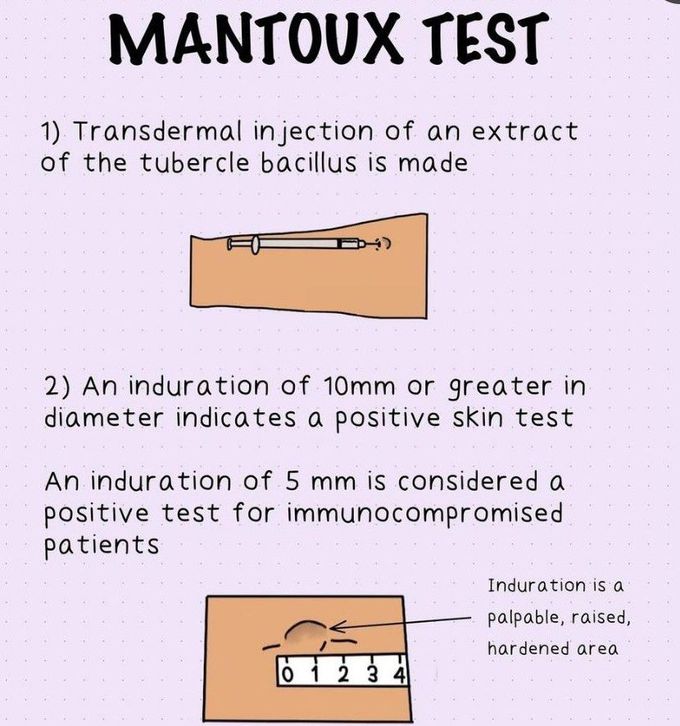 Mantoux Test