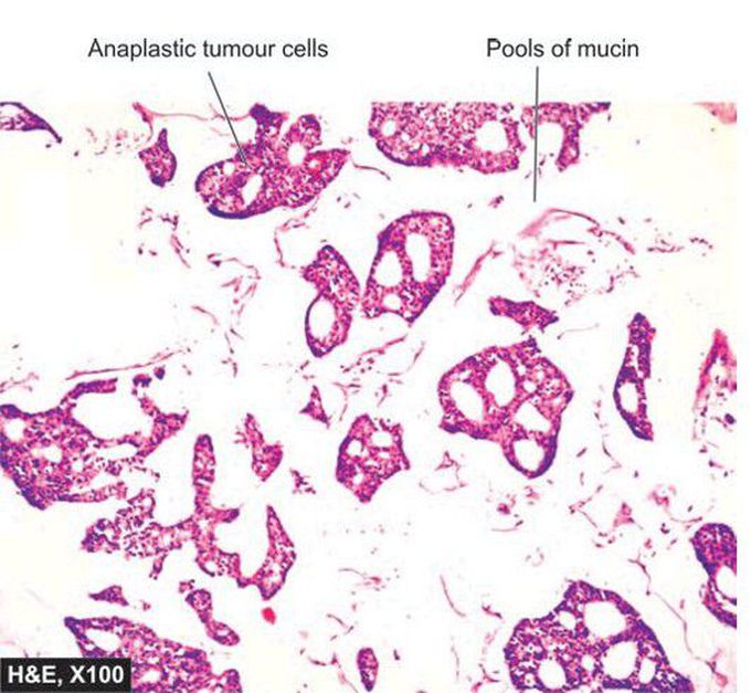 Colloid (mucinous) carcinoma breast.