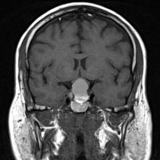 Diagnosis of pituitary adenomas