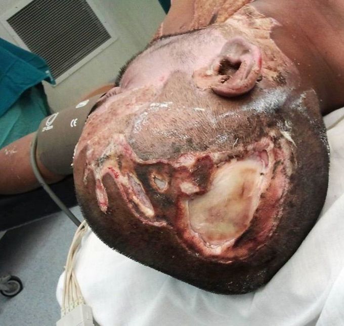 This young patient came too close to a high tension wire while working as an electrician which resulted in full thickness contact burns over his scalp leading to full thickness scalp loss,
flash burns on his face, neck and chest. 
The scalp wound has been covered with skin graft.