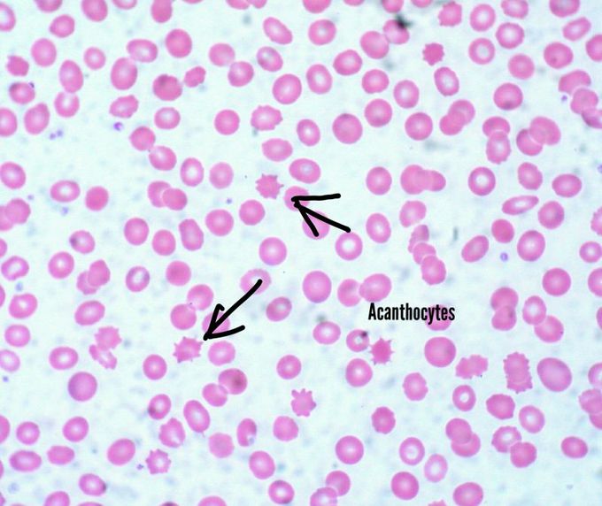 Acanthocytes of Peripheral Blood Smear