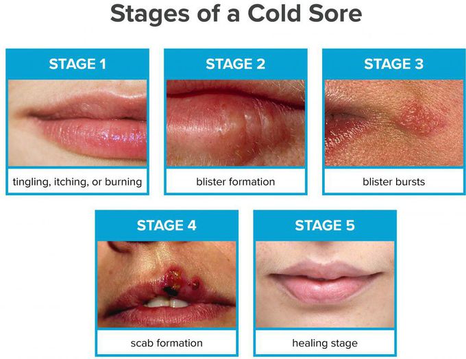 Cold sore