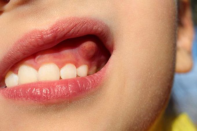 Abscess