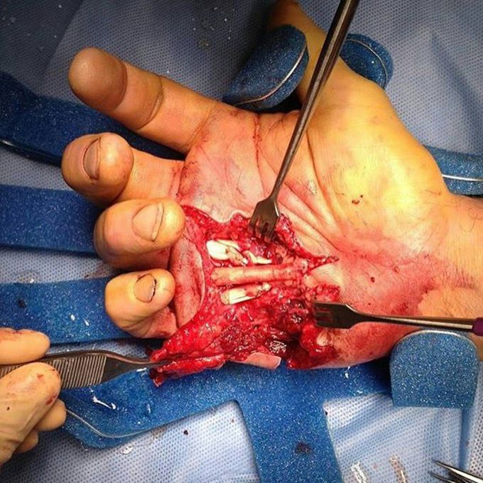 Reconstructive tendon repair