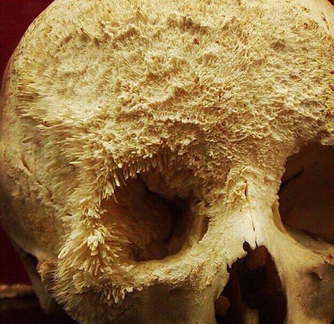 Bone cancer