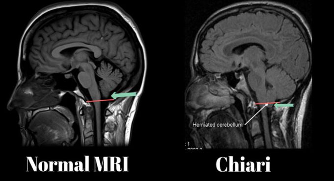 MRI Arnold Chiari malformation type ll