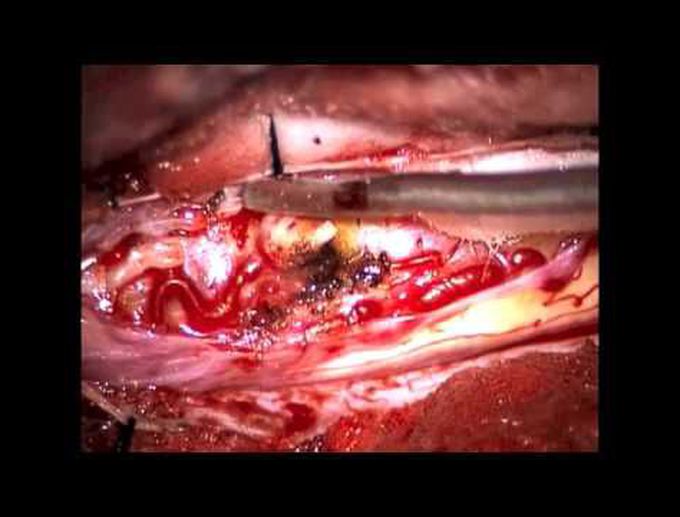 Microsurgical resection of intramedullary spinal cord hemangioblastoma
