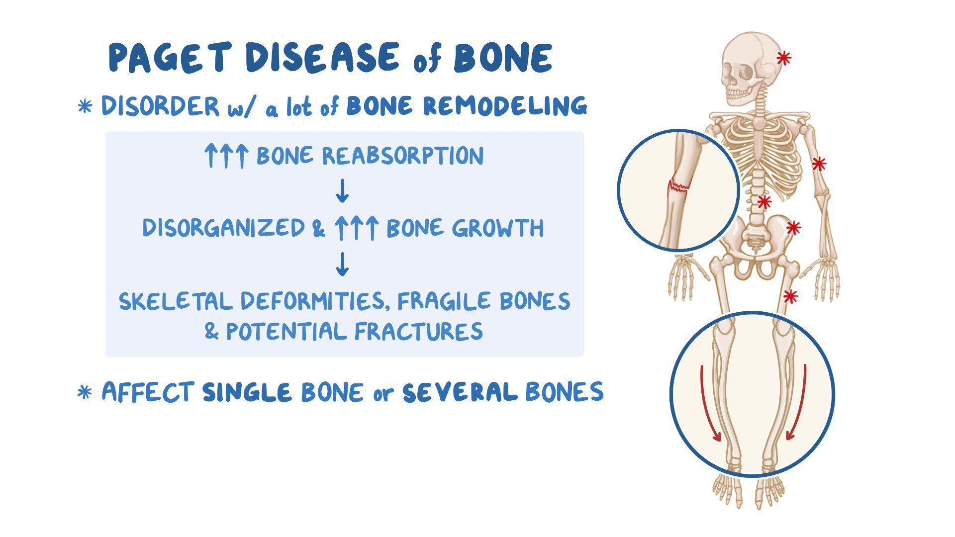 Paget Disease of the Bone