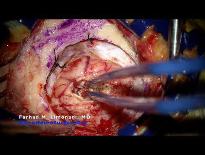 Brain surgery: Suboccipital craniotomy for resection of cerebellar metastatic brain tumor.