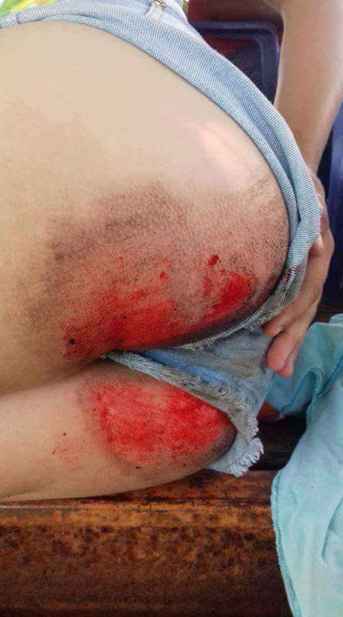 Motocross injuries.