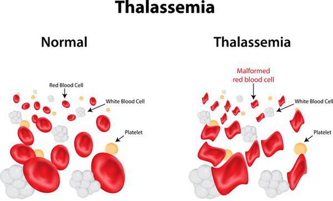 Thalassemia is an inherited blood disorder in which the body makes an abnormal form of hemoglobin. Hemoglobin is the protein molecule in red blood cells that carries oxygen.

The disorder results in excessive destruction of red blood cells, which leads to anemia. Anemia is a condition in which your body doesn’t have enough normal, healthy red blood cells.  The symptoms of thalassemia can vary.                    Some of the most common ones include:

bone deformities, especially in the face
dark urine
delayed growth and development
excessive tiredness and fatigue
yellow or pale skin