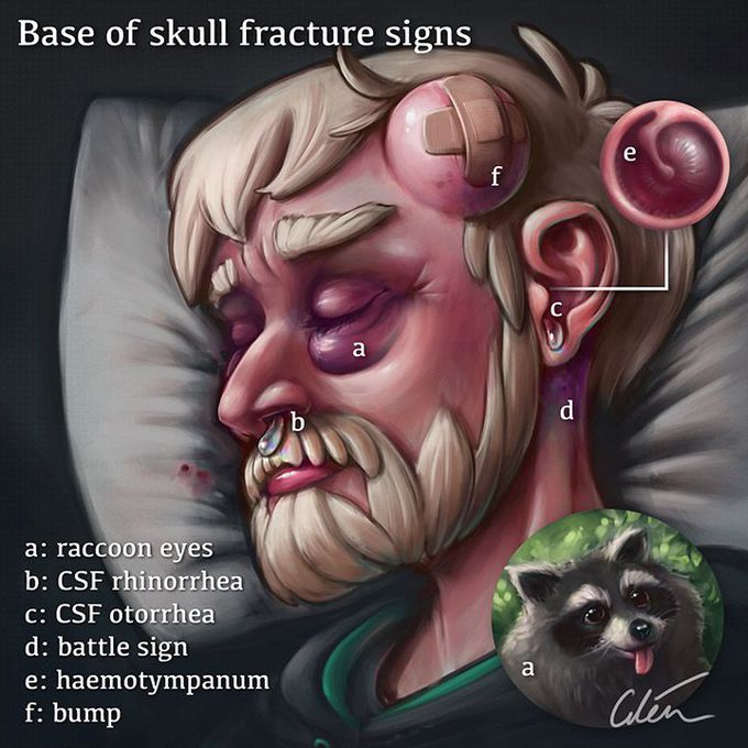Signs of Base of Skull Fracture